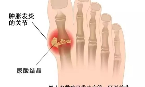 【手气图片和症状图片】手气的症状及治疗方法 - 手气脸上症状图片网